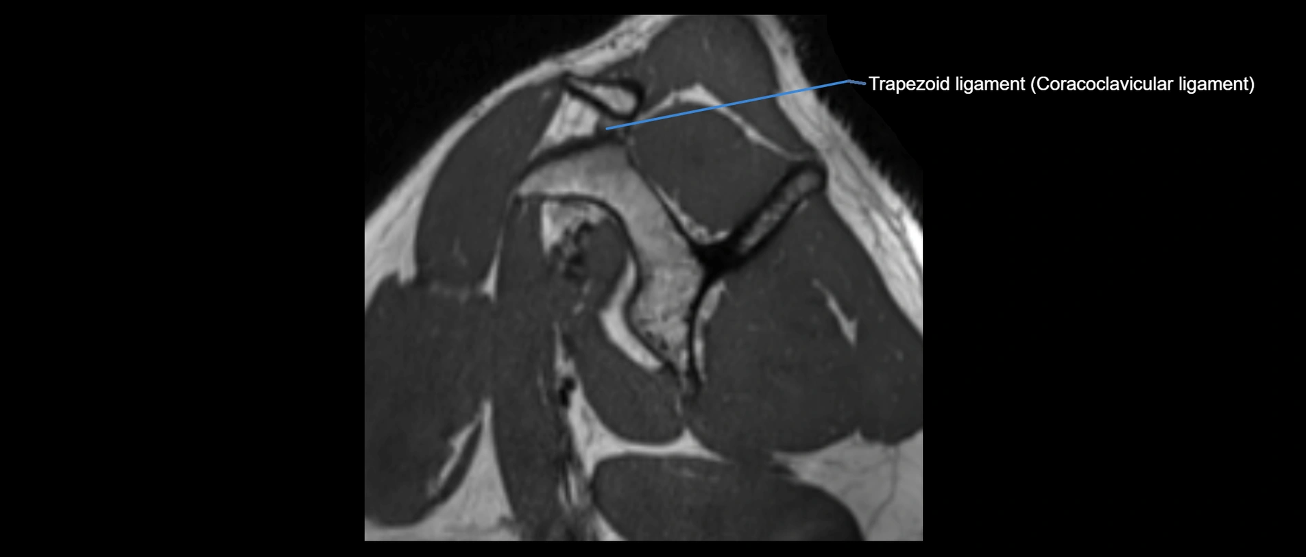 shoulder ligaments sagittal  cross sectional anatomy 3T MRI AI enhanced radiology image -img-00001-00018.webp